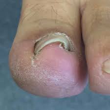 Twisted nail case study 3